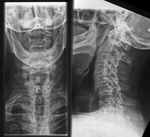 Raio-X da coluna cervical - um método para diagnosticar osteocondrose