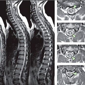 diagnóstico de osteocondrose torácica