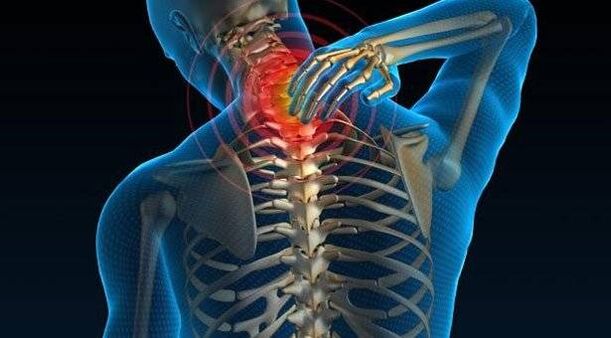 Osteocondrite da coluna